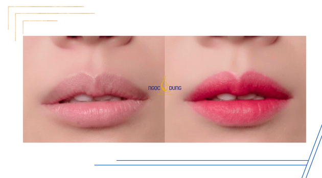 Hình ảnh trước và sau khi phun môi collagen tại Ngọc Dung