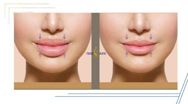 Phẫu thuật chỉnh hình môi