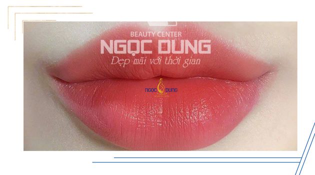 Phun môi bằng công nghệ Collagen tại TMV Ngọc Dung
