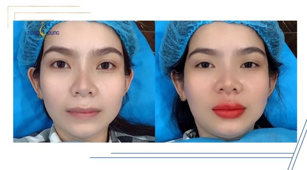 Hình ảnh khách hàng sau khi phun môi collagen màu đỏ cam