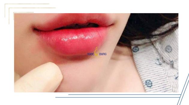 TMV Ngọc Dung điều trị thâm mép môi uy tín